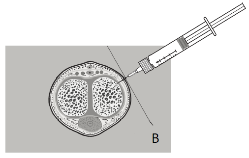 Caverject Dosage Image 9