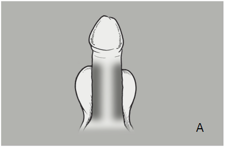 Caverject Dosage Image 8