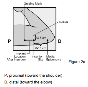 Implanon Dosage Figure 2a