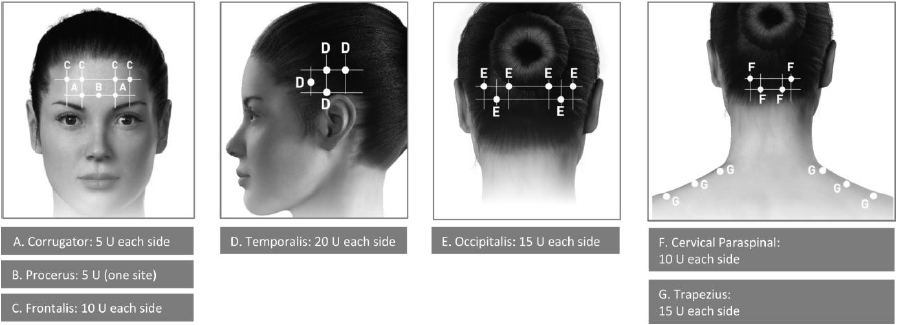 Botox Dosage Image 4