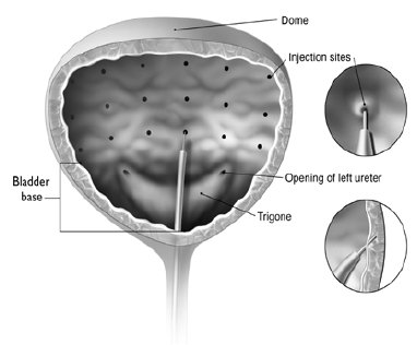 Botox Dosage Image 5