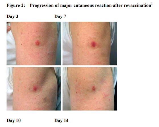 ACAM2000 Dosage Image 2