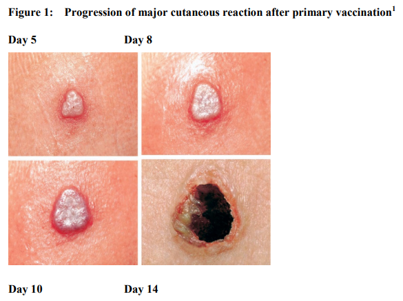 ACAM2000 Dosage Image 1